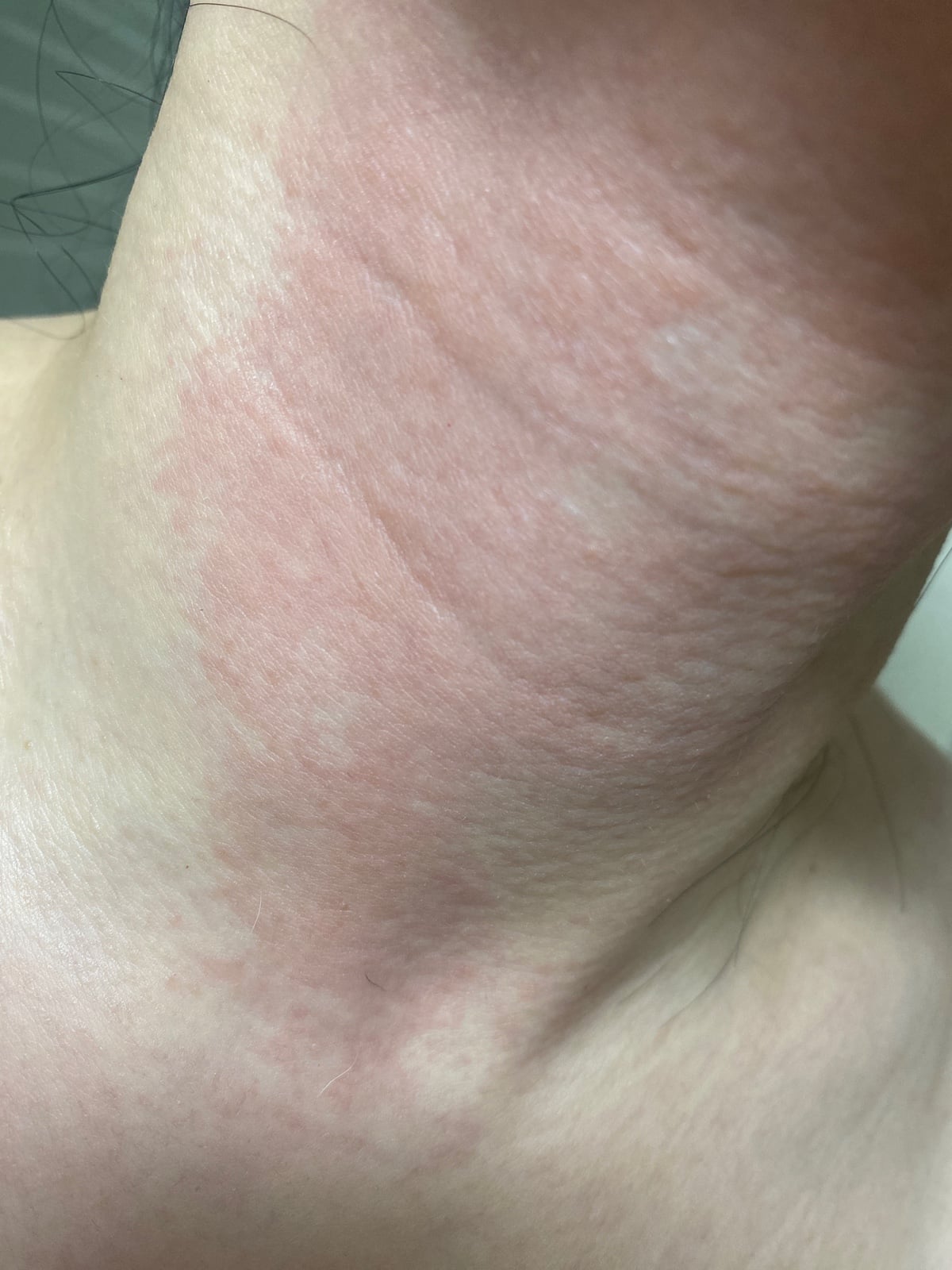 대상포진 무료접종 대상